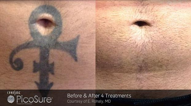 PicoSure tattoo removal before and after.