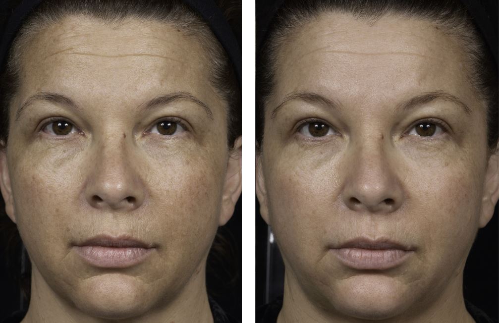 Sun damaged skin before and after.
