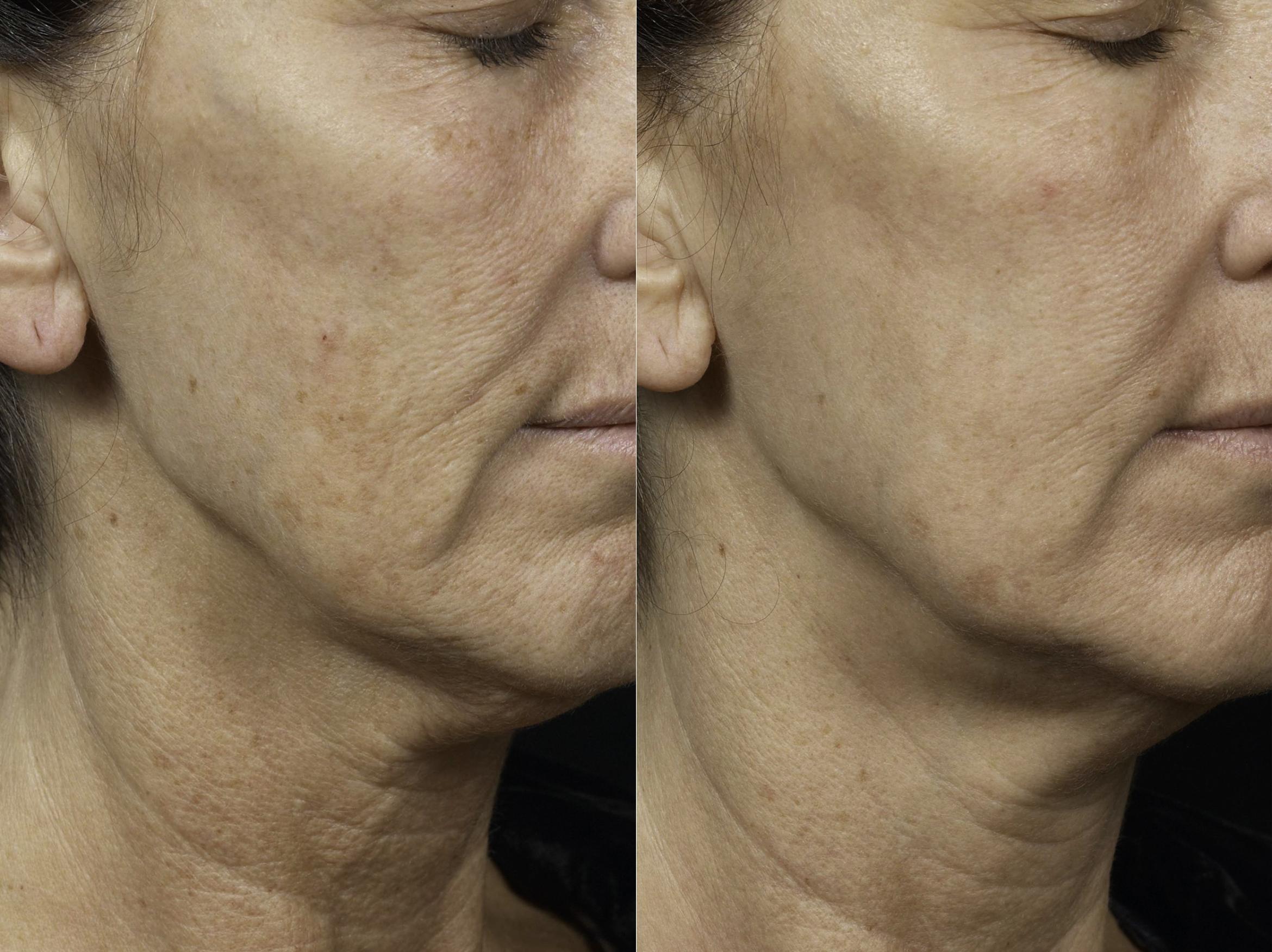 Before and after pictures of a woman's cheeks showing less skin discoloration after Fraxel treatment.