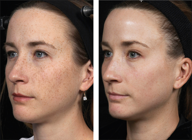 Fraxel before and after for freckles.