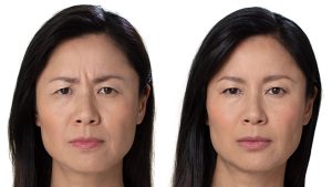 Before and after BOTOX photos of a woman's face showing the absence of frown lines in the after photo.