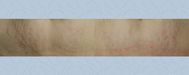 stretchmark treatment before and after