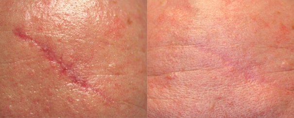 scar treatment before and after