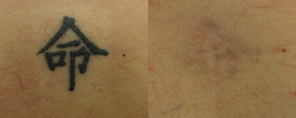 Lutronic on Twitter Have you heard that tattoo removal requires several  treatments Well we have proof with the right device it can be done fast  InkFreeMD Houston removed this 30yearold professional tattoo