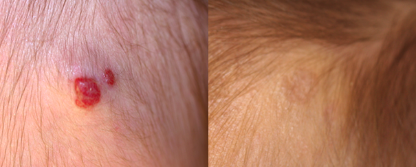 hemangioma treatment before and after