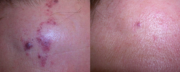 port wine stain treatment before and after