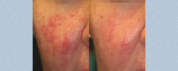 facial rosacea treatment before and after