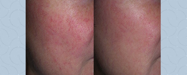 facial spider vein treatment before and after