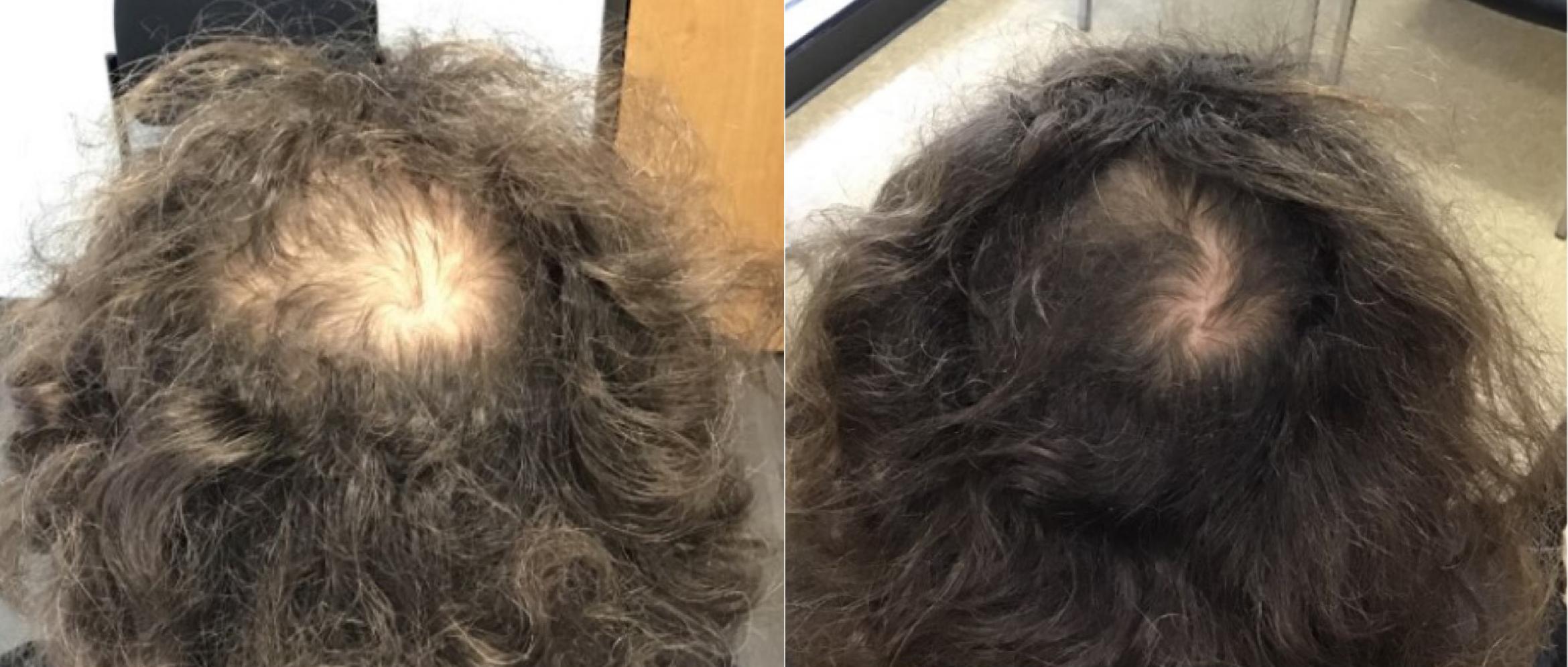 The crown of a patient's head before hair restoration and 7 months after treatment showing hair regrowth.