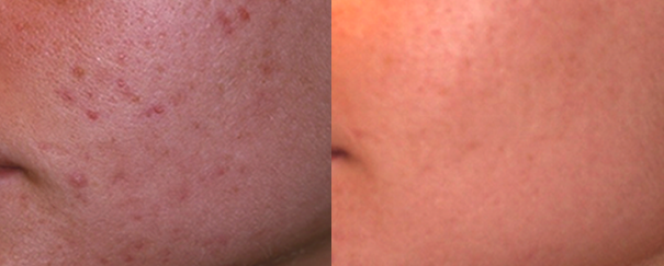 Acne scarring before and after.