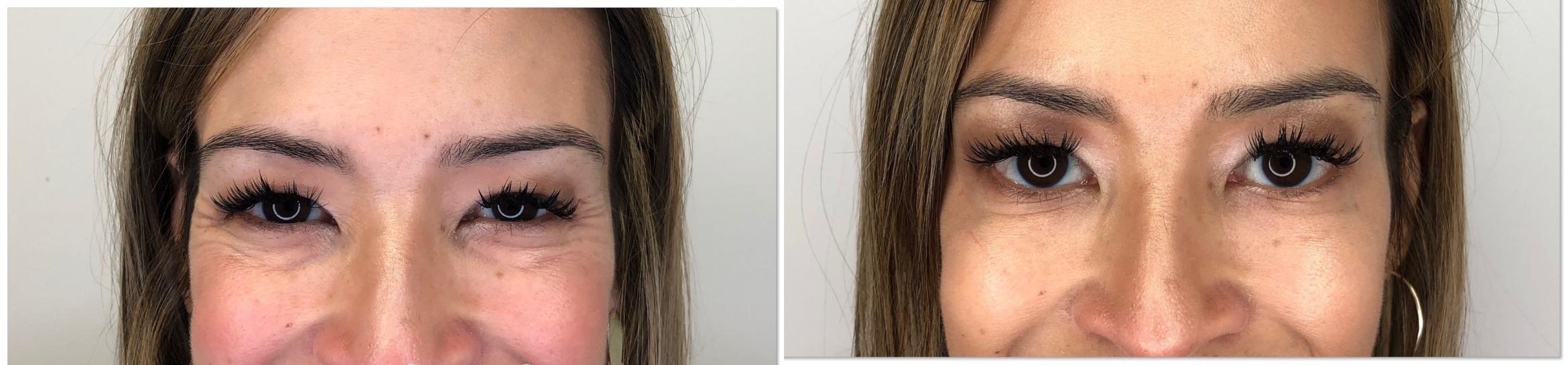 Close-up of woman's eyes before and after BOTOX treatment showing much younger-looking eyes in the after photo.