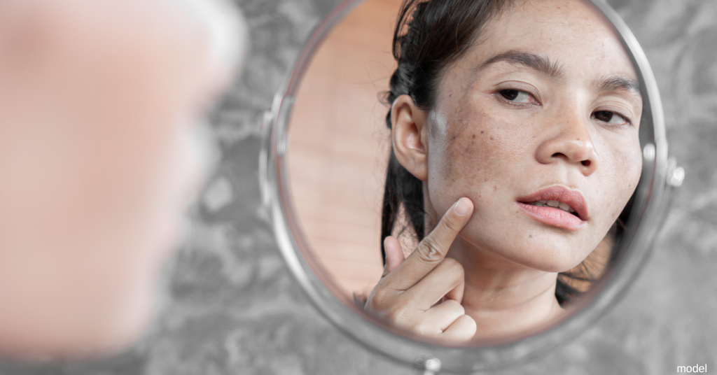 woman examines sun damage (model)