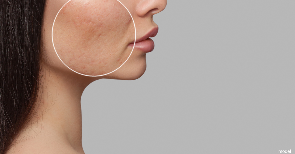 closeup of woman with acne scarring (model)