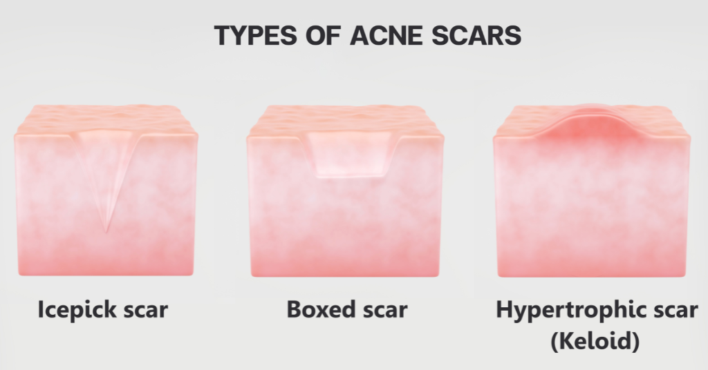 Types of Acne Scars - Icepick Scar, Boxed Scar, Hypertrophic Scar