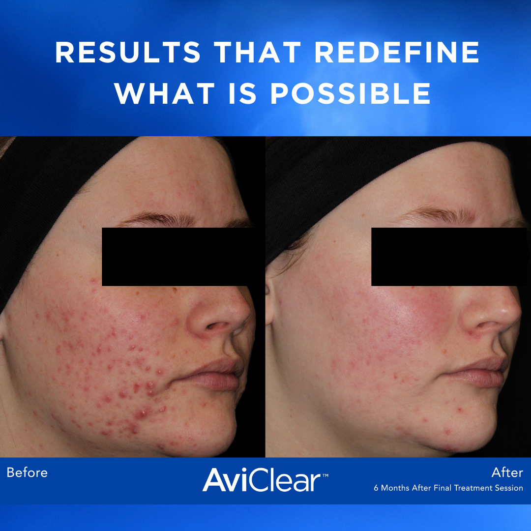 Acne Removal Treatments For Acne On Arms