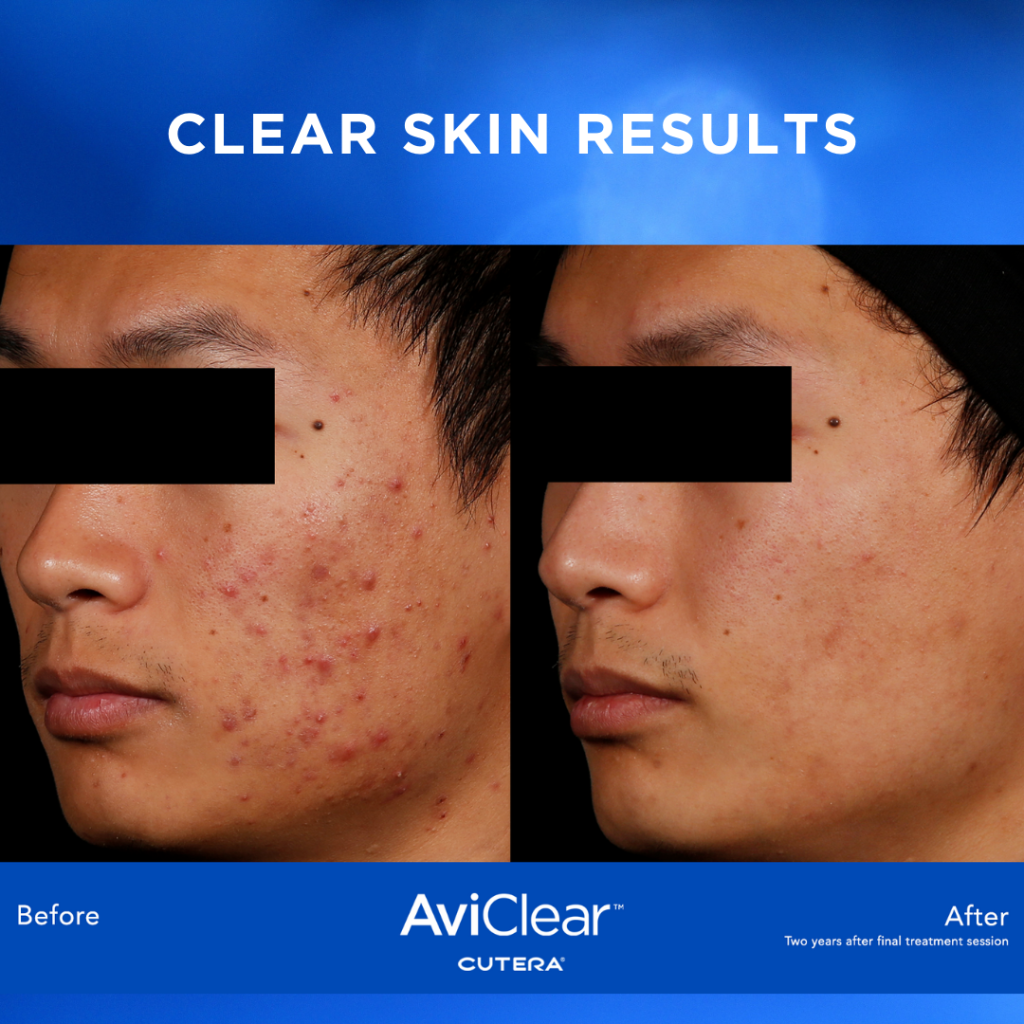 AviClear acne treatment before and after
