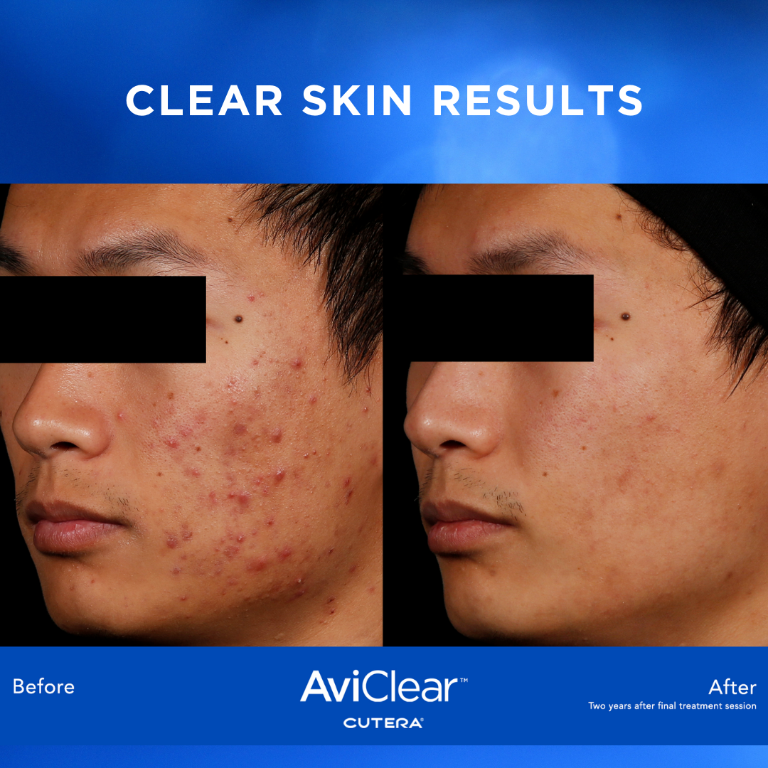 Aviclear Laser Acne Treatment By A Greater Houston Tx Dermatologist Dermsurgery Associates 