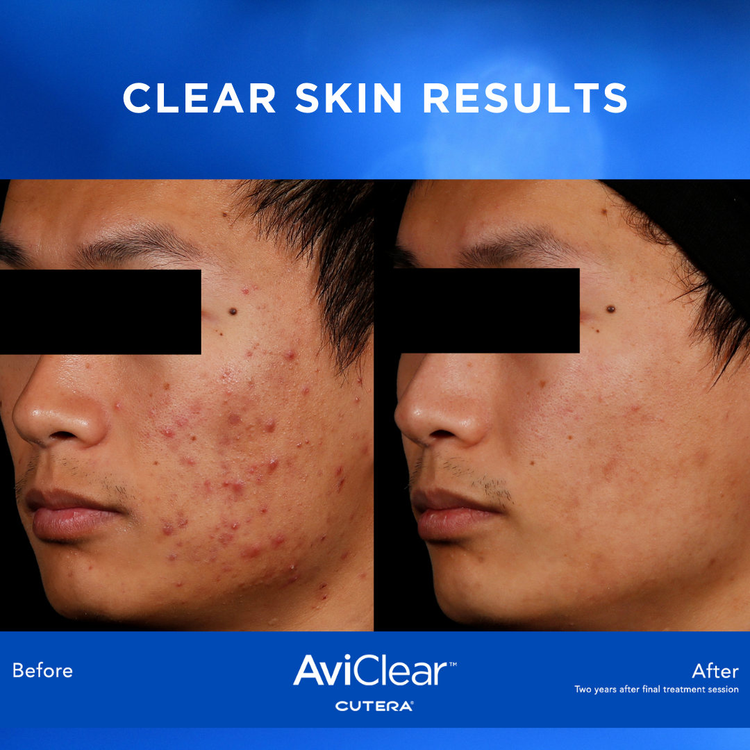 AviClear Laser Acne Treatment By A Greater Houston TX Dermatologist 