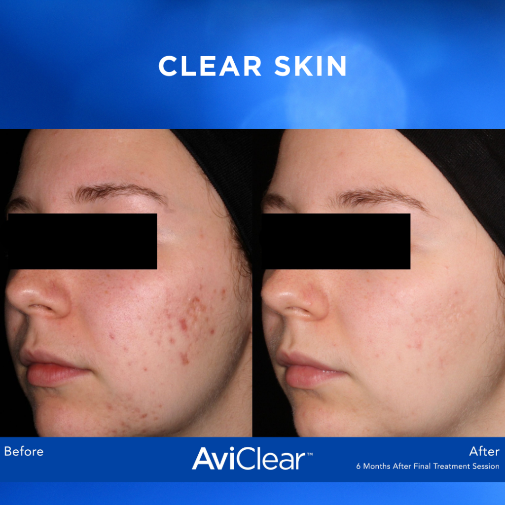AviClear before & after photo with text that reads "Clear Skin"