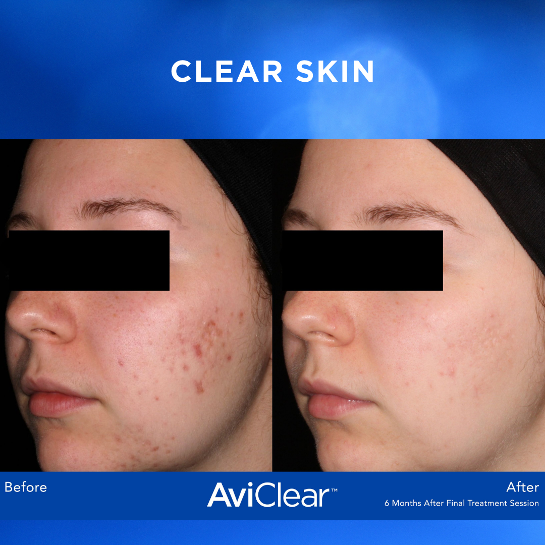 AviClear Laser Acne Treatment by a Greater Houston, TX, Dermatologist