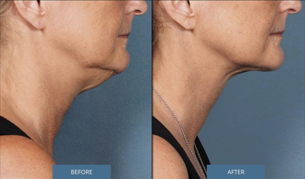 Face profile: before and after KYBELLA