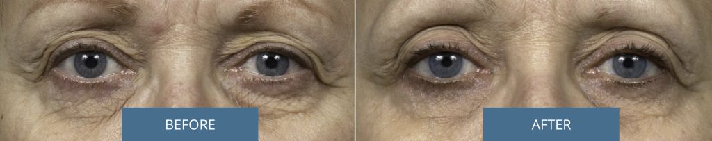 Before and after Thermage around the eye area