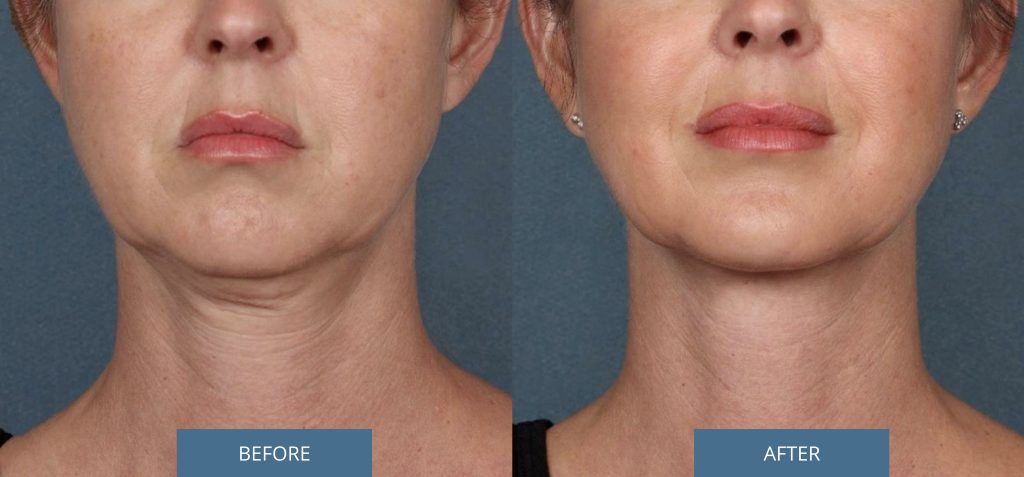 Profile: before and after KYBELLA