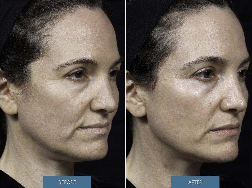 Side profile: before and after Thermage on the face