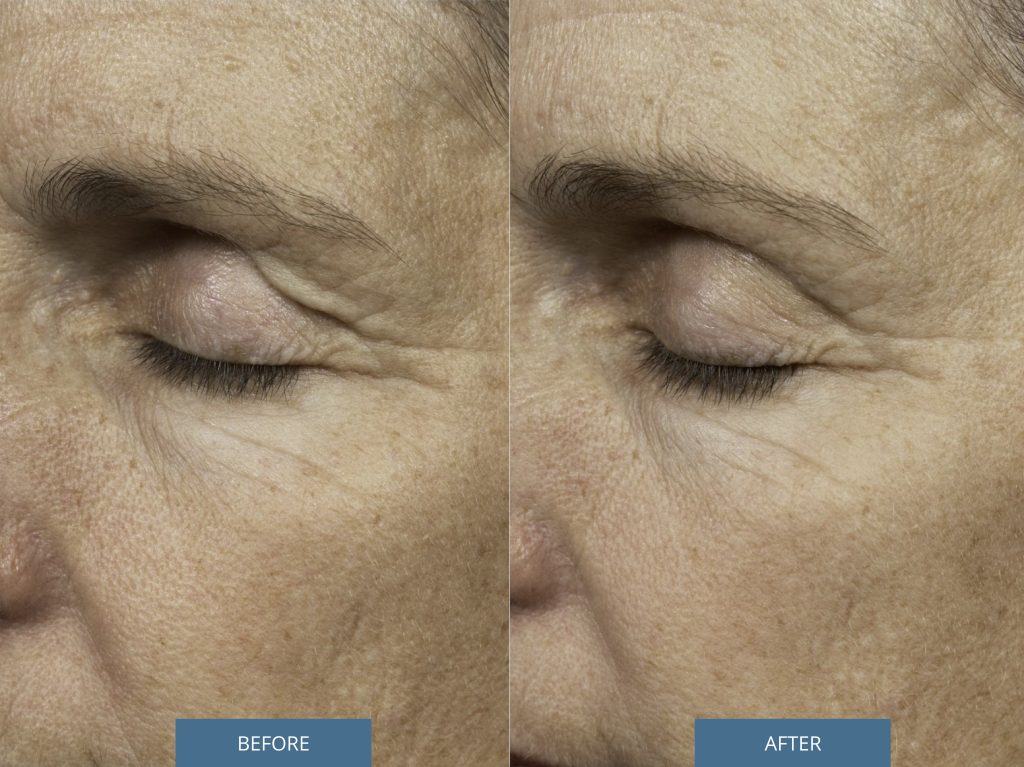 Before and after Thermage on the upper eyelids