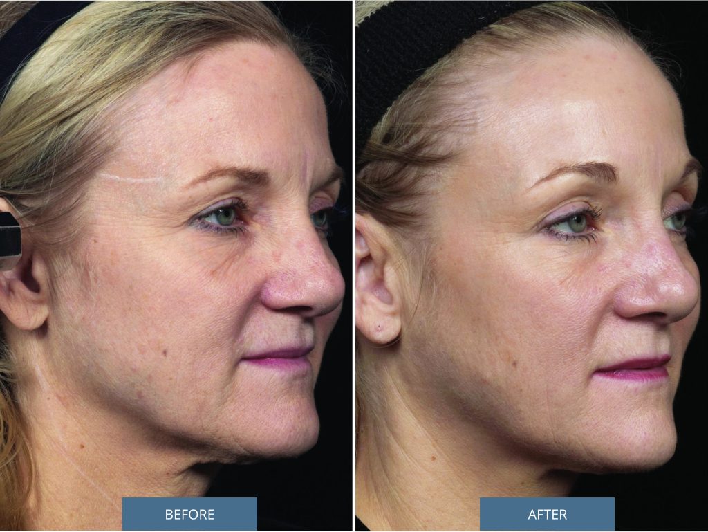 Side profile: before and after Thermage on the face