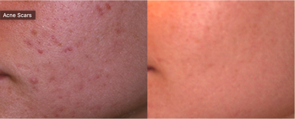 before & after acne scar treatment