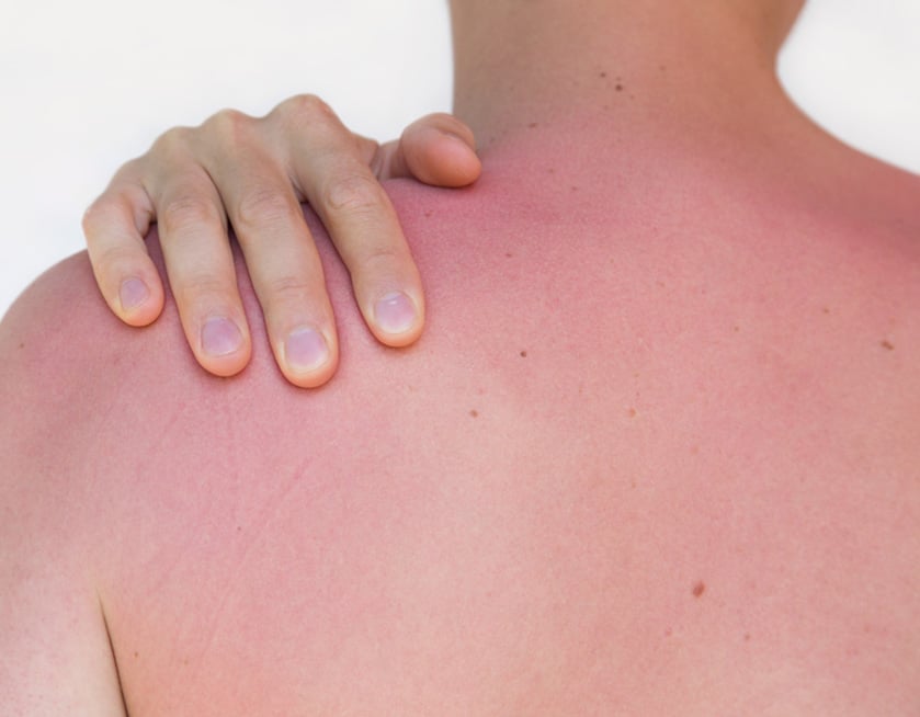 Going out in the sun? Why neglecting to use sunscreen can be deadly.