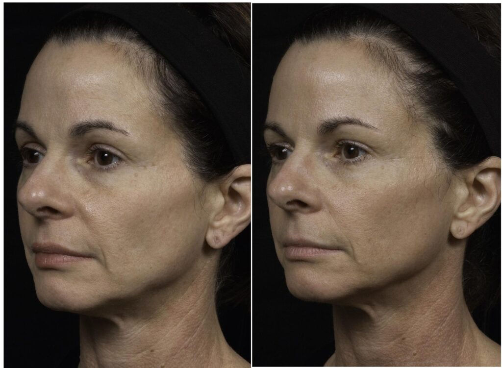 Are Wrinkles and Sagging Skin a Problem? Thermage® Is the Solution. (Updated 2024)