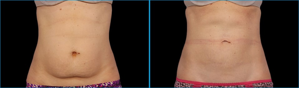 Eliminate Unwanted Body Fat with CoolSculpting® and Amp Up Your Confidence