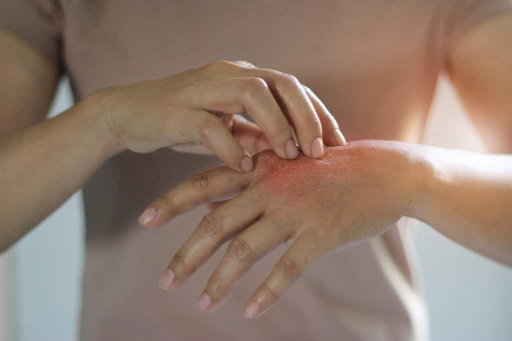 What Triggers Eczema? Tips for Relief and Prevention