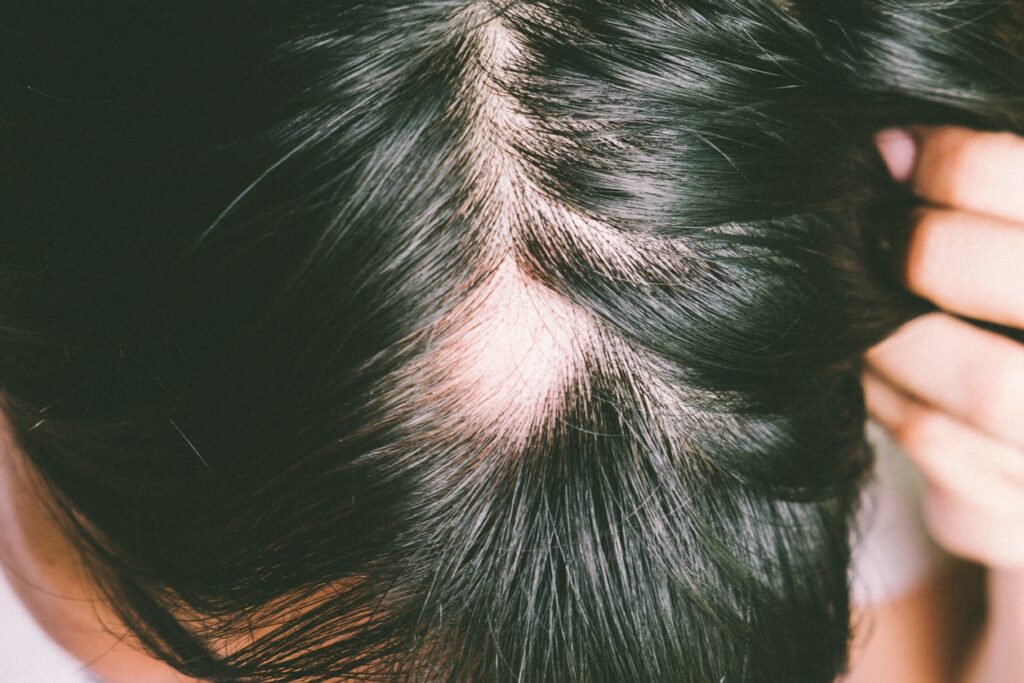 What Is Alopecia & What Is the Best Way to Treat It?