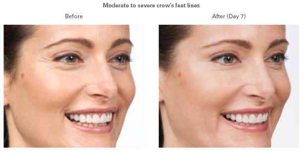 BOTOX®: What Can It Do for Me?