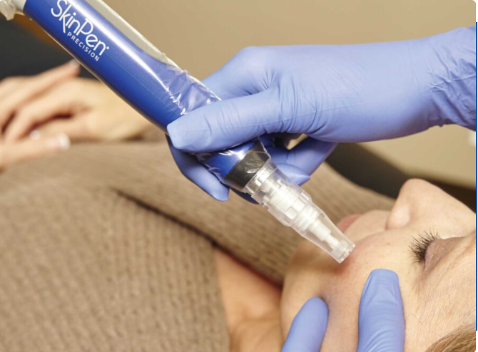 actual patient receiving Skinpen microneedling