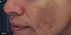 cutera limelight discoloration before