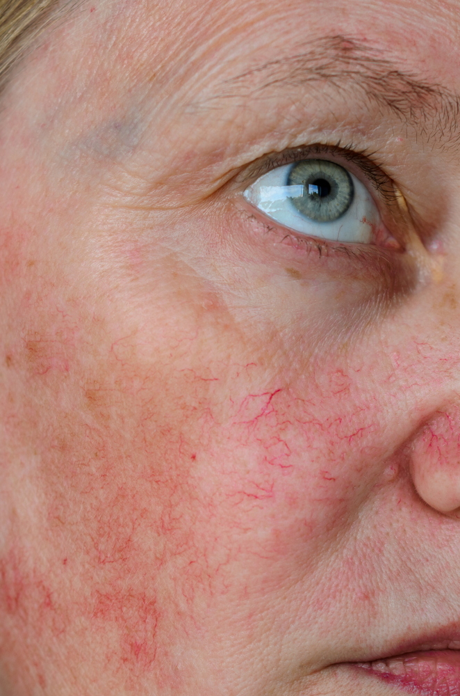 Rosacea Treatment in Houston and Greater Houston, TX
