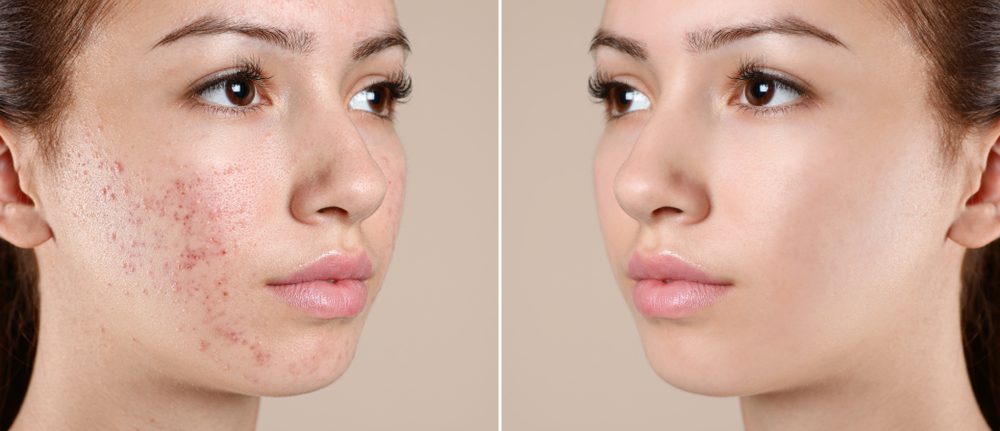 Acne Treatment in Houston and Greater Houston, TX