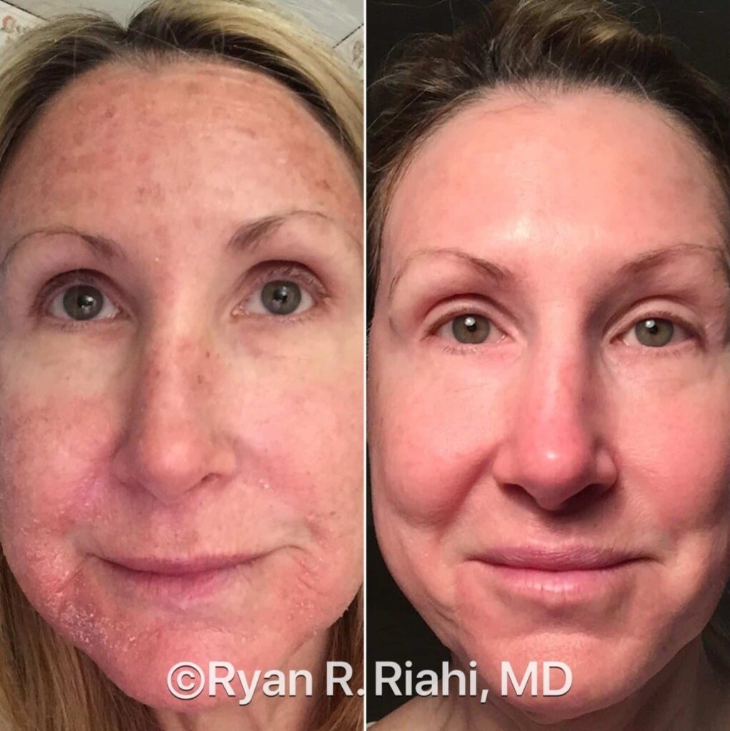 Sun Damage Treatment Before & After Case 46