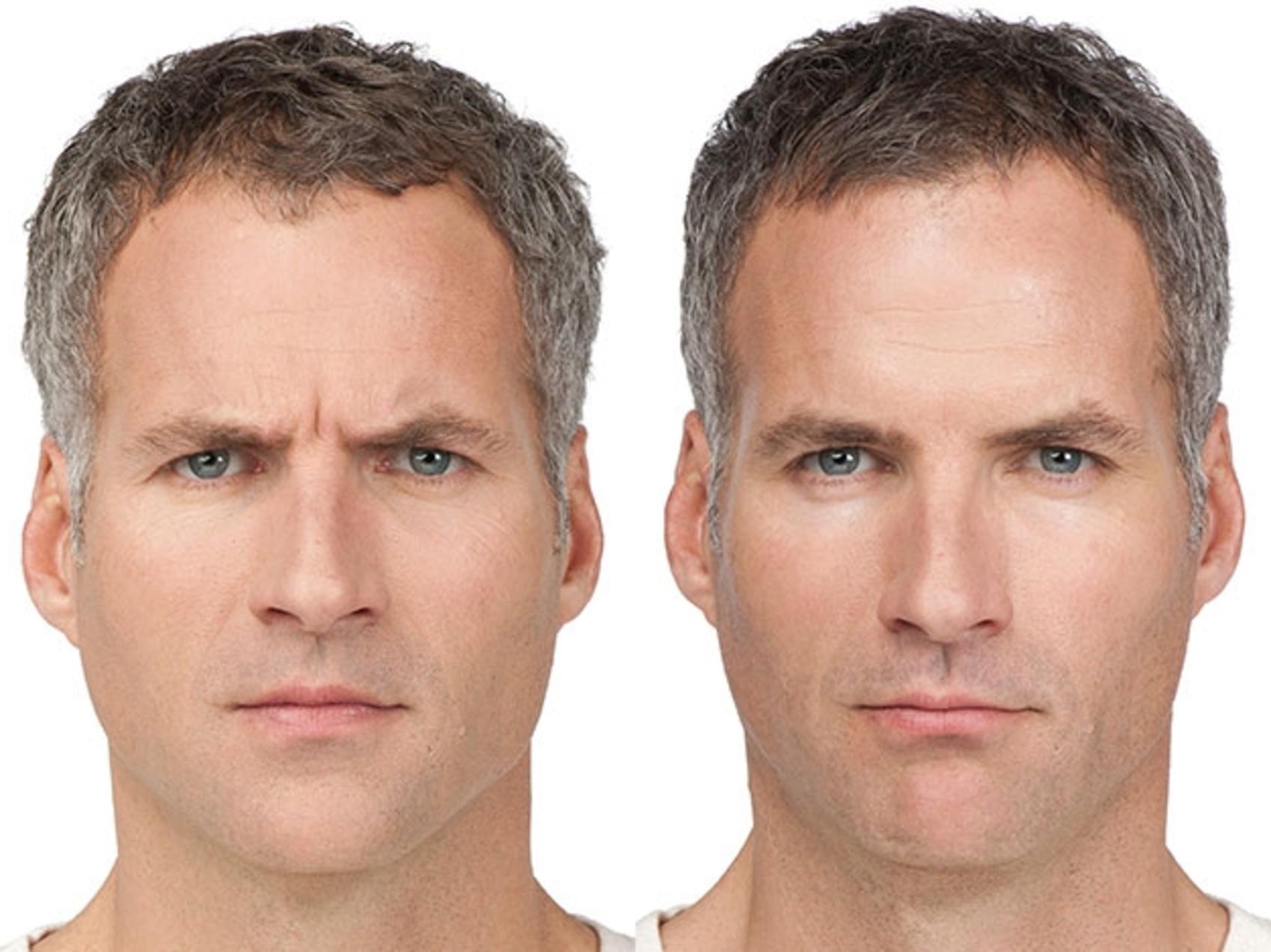 Before and After Image: Case #11 - front