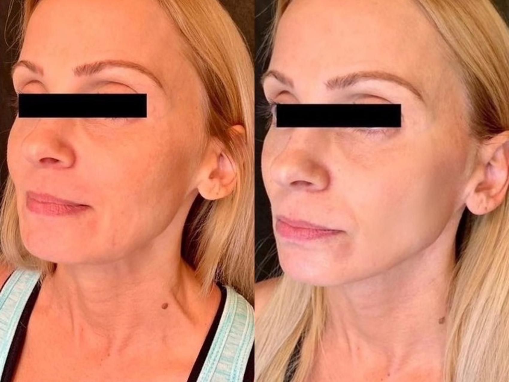 Before and After Image: Case #54 - left-front-oblique