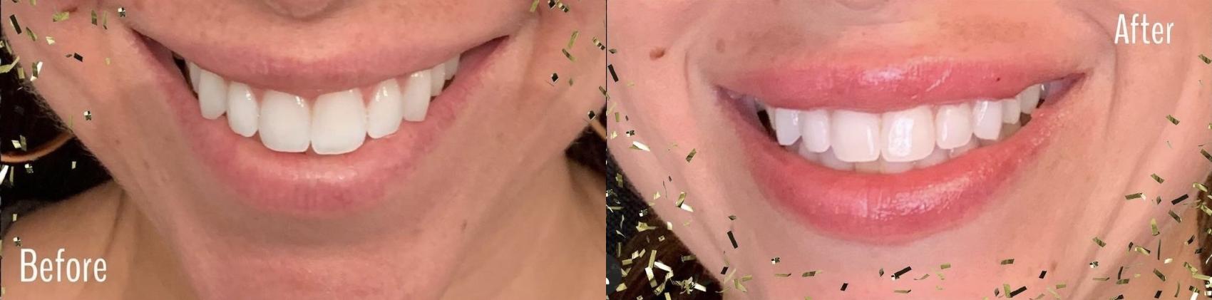 Before and After Image: Case #55 - front