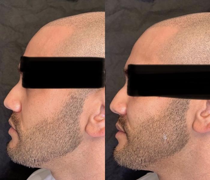 Before and After Image: Case #61 - left-side