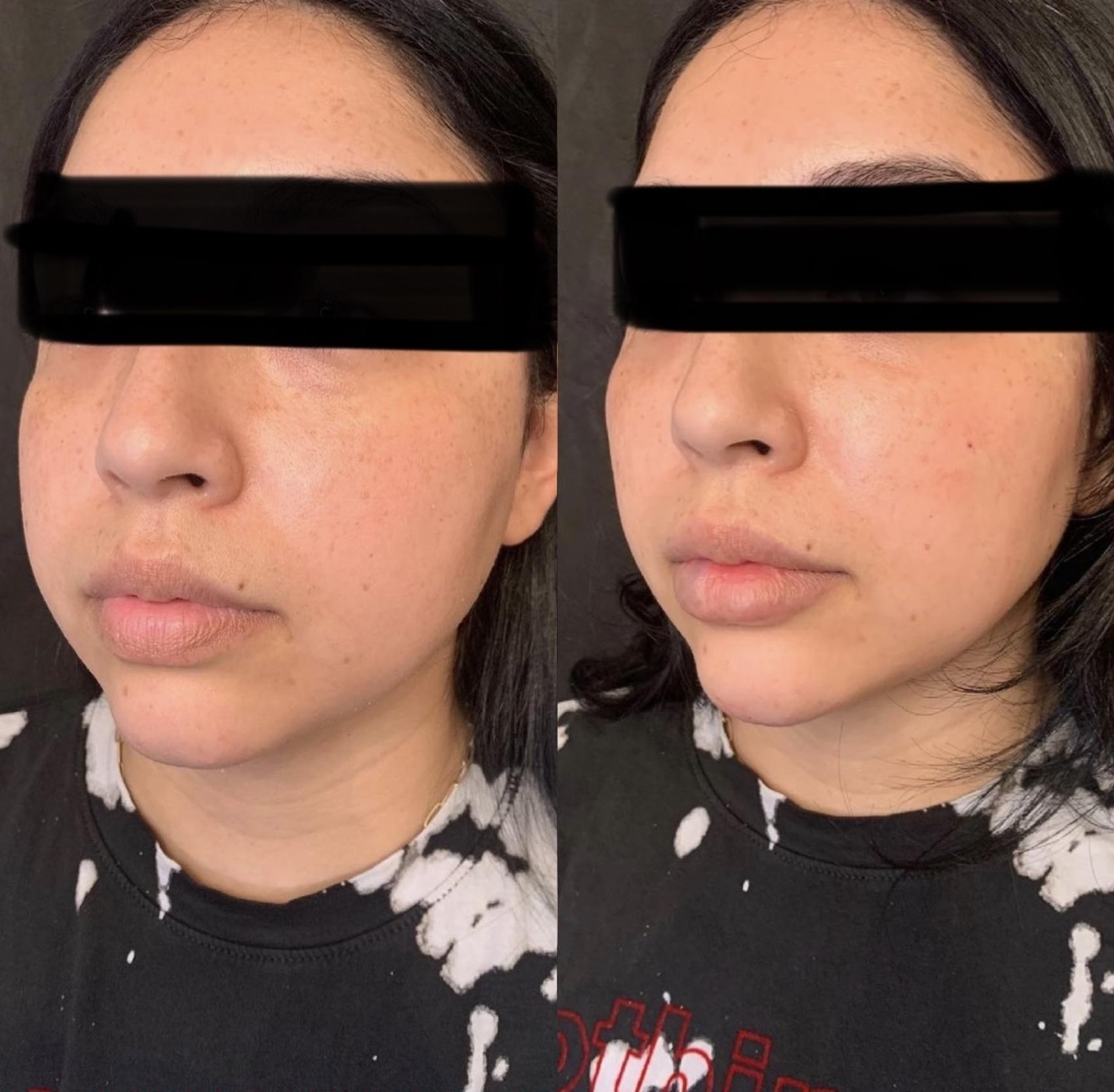 Before and After Image: Case #62 - left-front-oblique