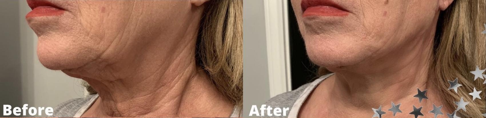 Before and After Image: Case #63 - left-front-oblique