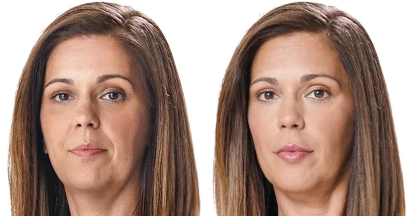 Before and After Image: Case #6 - front