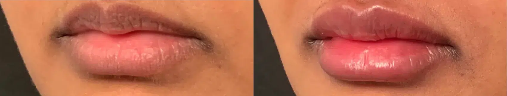 Before and After Image: Case 67 - left-front-oblique